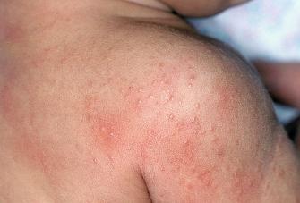 Got heat rash? Here's how to identify and treat the condition - Etre Vous