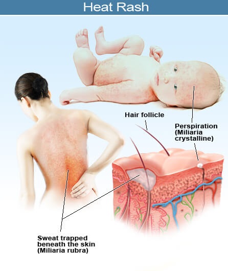 HSHS Holy Family Hospital - Heat rash is common during hot weather. It is  caused by blocked sweat ducts and trapped sweat beneath the skin. Here are  tips to treat it at