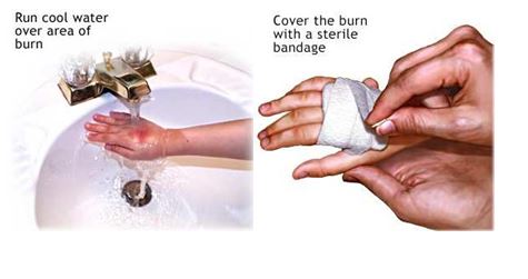 First aid top for minor burns